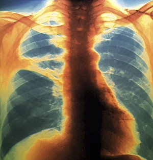 Prints of Coloured X-ray (front view) of the chest in a 58 year old patient showing collapse (atelectasis) of part of the upper lobe of a lung (orange, at left) Images Dated 2011 April: Colour X-ray Print of Lung Collapse