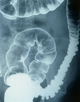 Images Dated 1st March 2013: Double Contrast Colonic Spasm Print