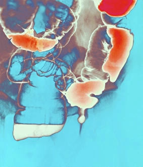 Coloured barium X-ray of an inguinal hernia Coloured barium X-ray of an inguinal hernia