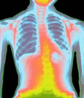 Images Dated 10th October 2003: Coloured chest X-ray showing pneumonia