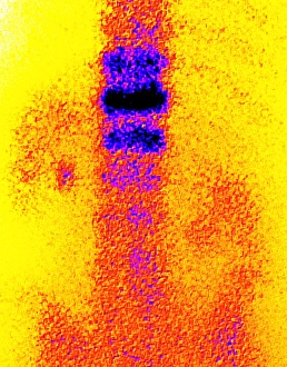 Coloured gamma scan of osteoporosis in vertebra Coloured gamma scan of osteoporosis in vertebra