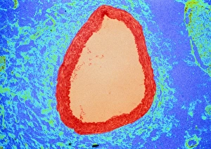 Coloured LM of a section through a coronary artery Coloured LM of a section through a coronary artery