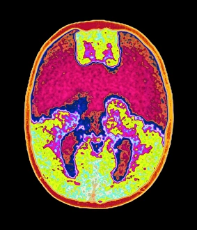 Coloured MRI brain scan showing holoprosencephaly Coloured MRI brain scan showing holoprosencephaly
