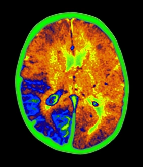 Coloured MRI brain scan of Sturge-Weber syndrome Coloured MRI brain scan of Sturge-Weber syndrome