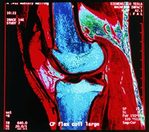 Coloured MRI scan of human knee joint, side view Coloured MRI scan of human knee joint, side view