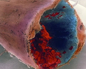 Coloured SEM of a blood clot in coronary artery Coloured SEM of a blood clot in coronary artery