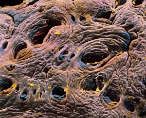 Coloured SEM of intestine, showing coeliac disease Coloured SEM of intestine, showing coeliac disease