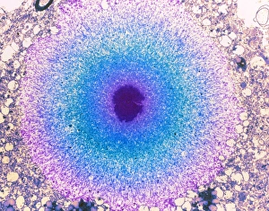 Coloured TEM of a Lewy body in Parkinsons disease Coloured TEM of a Lewy body in Parkinsons disease