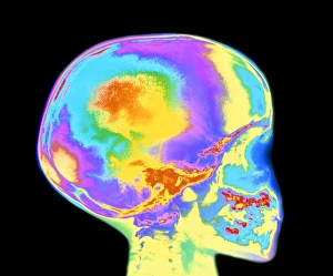 Coloured X-ray of childs skull and tooth eruption Coloured X-ray of childs skull and tooth eruption
