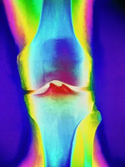 Coloured X-ray of a human knee joint Coloured X-ray of a human knee joint