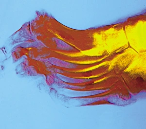 Coloured X-ray of rheumatoid arthritis of a foot Coloured X-ray of rheumatoid arthritis of a foot