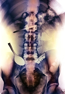 Coloured X-ray of spoon and blade in intestine Coloured X-ray of spoon and blade in intestine