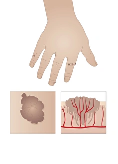Prints of Common warts (Verruca vulgaris), artwork. The diagram at bottom right shows capillaries that have grown into teh wart to supply it with oxygen and nutrients Images Dated 2010 October: Common Wart Print