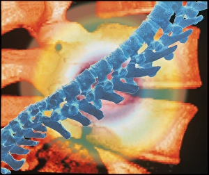 Computer artwork of a spine depicting back pain Computer artwork of a spine depicting back pain