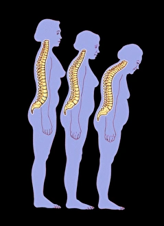 Computer artwork of woman developing kyphosis Computer artwork of woman developing kyphosis