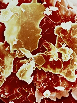 Crystals of cholesterol Crystals of cholesterol