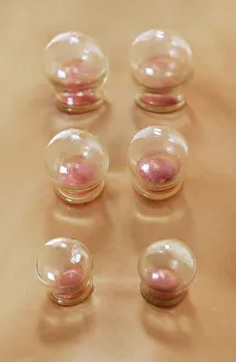 Prints of MODEL RELEASED. Cupping. Cupping, or fire cupping, is a practice derived from Chinese medicine and is used in the treatment of respiratory conditions and musculoskeletal pains Images Dated 2006 April: Cupping Print