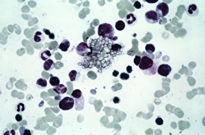 Light Microscopy Images Prints: Cystine in bone marrow, light micrograph