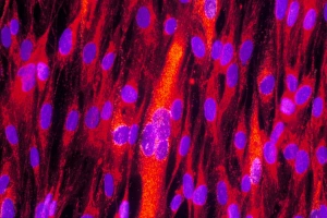 Cytomegalovirus infection Cytomegalovirus infection