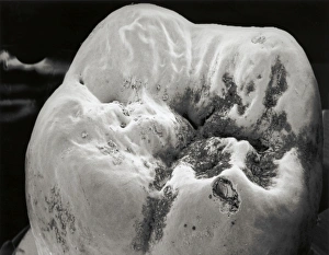 Prints of Tooth decay. Scanning electron micrograph (SEM) of the surface of a decaying molar tooth. The surface enamel (white) has begun to break down (for example, at lower right) Images Dated 2003 March: SEM Print of Decaying Molar Tooth