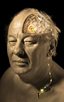 Prints of MODEL RELEASED. Deep brain stimulation (DBS), cutaway computer artwork Images Dated 2009 March: Deep Brain Stimulation Print