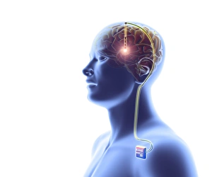 Deep Brain Stimulation Print, Computer Artwork