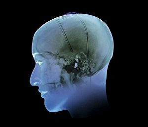 Deep Brain Stimulation Print: X-ray of 3D Head Model with DBS Electrodes