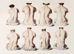 Osteoporosis Symptoms Prints: Back deformities