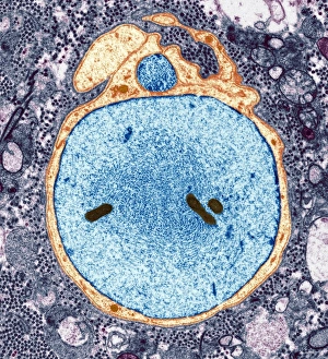 Coloured TEM Micrograph Prints: Demyelinated nerve in multiple sclerosis