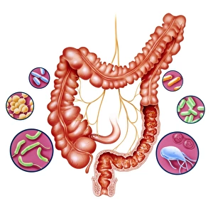 Diarrhoea, artwork Diarrhoea, artwork