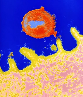 Diphtheriae bacterium in throat Diphtheriae bacterium in throat