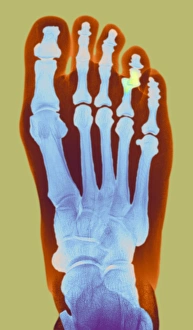 Images Dated 2008 January: Dislocated Toe X-ray Print