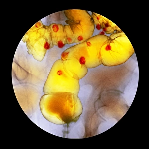Diverticulitis, X-ray F008/3454 Diverticulitis, X-ray F008/3454