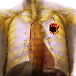 Dual chamber pacemaker, X-ray F008/3508 Dual chamber pacemaker, X-ray F008/3508