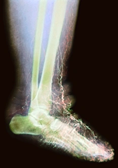 Images Dated 27th August 2002: Elephantiasis Print