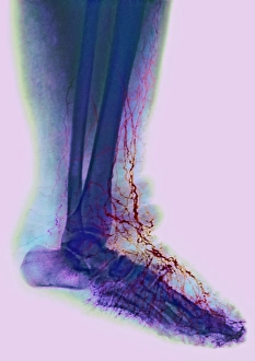 Prints of Elephantiasis. Coloured X-ray showing the lower leg of a patient with elephantiasis, a condition where the lymph vessels (red) become blocked Images Dated 2002 August: Coloured X-ray Print of Elephantiasis Affected Lower Leg
