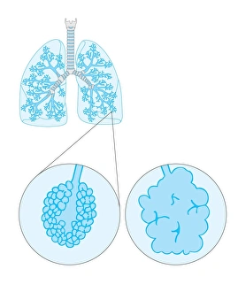 Lung Disease Symptoms Prints: Emphysema, artwork