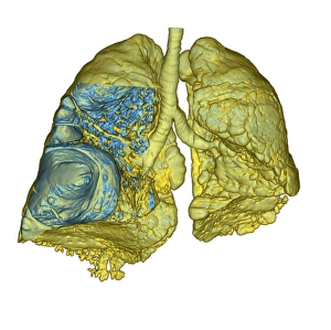 CT Scan Print of Emphysema Affected Lung