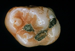 Extracted molar showing 3 amalgam fillings Extracted molar showing 3 amalgam fillings