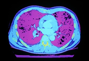 False-colour CT scan of normal heart & lungs False-colour CT scan of normal heart & lungs