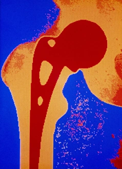 False colour x-ray of prosthetic hip joint False colour x-ray of prosthetic hip joint