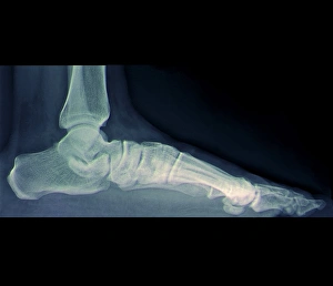 Prints of Coloured X-ray (side view) of the flat foot of a standing patient Images Dated 2011 April: Flat Foot, X-ray Coloured Print (Side View)