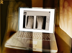Foot X-rays on a laptop computer, artwork Foot X-rays on a laptop computer, artwork