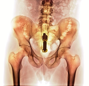 Foreign object in rectum, X-ray F008/3480 Foreign object in rectum, X-ray F008/3480