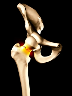 Fractured Hip Bone Print