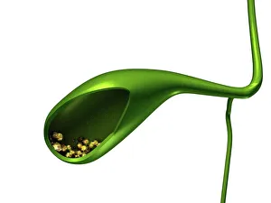 Gallstones, artwork Gallstones, artwork