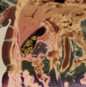 Gallstones, MRI scan Gallstones, MRI scan