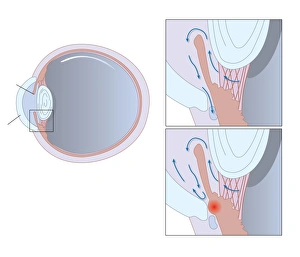 Glaucoma Treatment Prints: Glaucoma, artwork