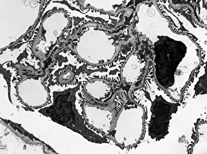 Prints of Glomerulus. Transmission electron micrograph (TEM) of a section through a nephron in a human kidney, showing a cluster of capillaries within a renal corpuscle, also known as a glomerulus Images Dated 2013 February: TEM Print of Glomerulus in Human Kidney