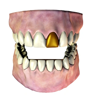 Images Dated 7th August 2006: Gold Tooth Print: A single adult tooth with a gold incisor replacement